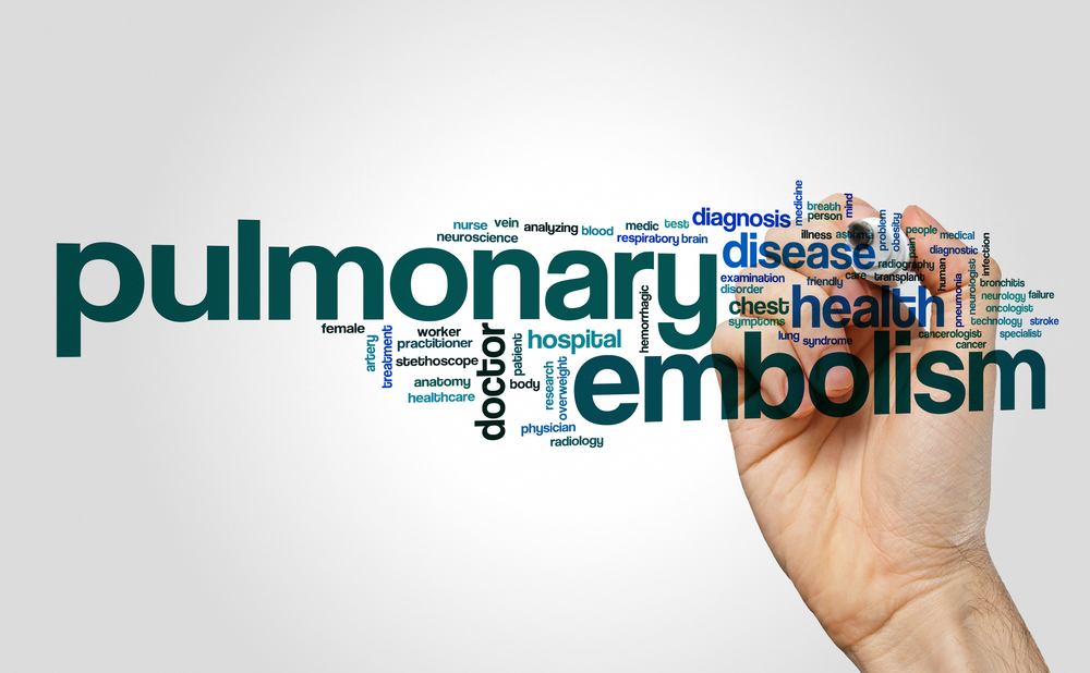 Pulmonary Embolism: For Some Clots, It Takes a Village