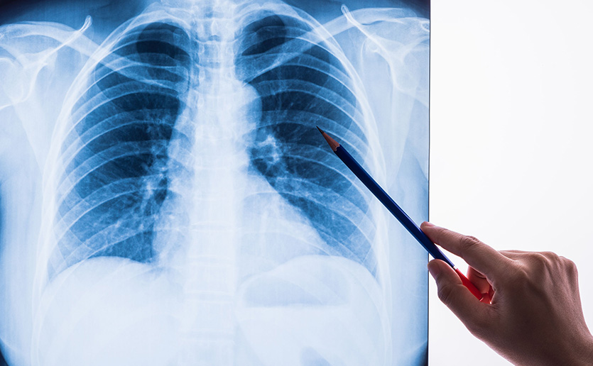 Chest X-rays May Provide New Health Risk Clues