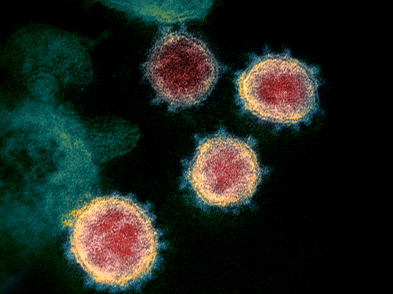 SARS-CoV-2 cells as seen under an electron microscope. (Photo courtesy of NIAID)